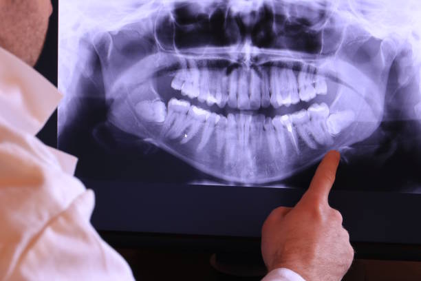 Best Knocked-Out Tooth (Avulsed Tooth) Treatment in Bolivar, MO