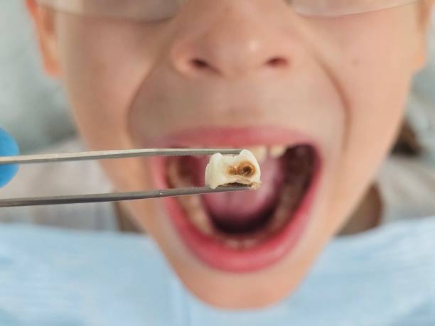 Best Emergency Wisdom Tooth Extraction in Bolivar, MO